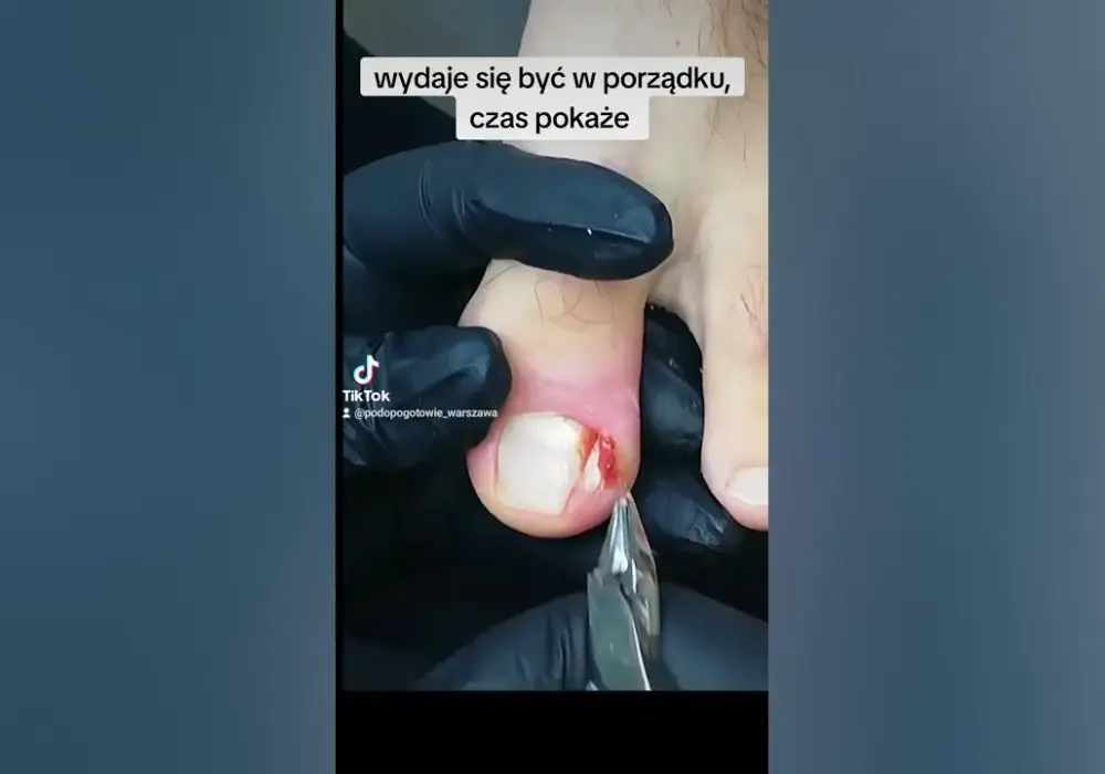 Jak wyciąć wrastający paznokieć i uniknąć bólu oraz komplikacji