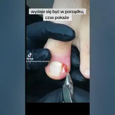 Jak wyciąć wrastający paznokieć i uniknąć bólu oraz komplikacji