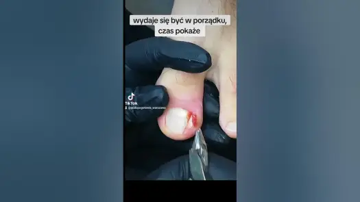 Jak wyciąć wrastający paznokieć i uniknąć bólu oraz komplikacji